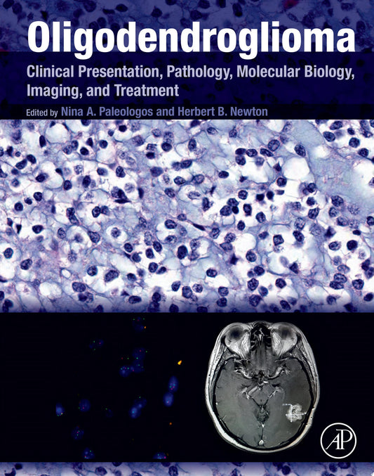 Oligodendroglioma: Clinical Presentation, Pathology, Molecular Biology, Imaging, and Treatment